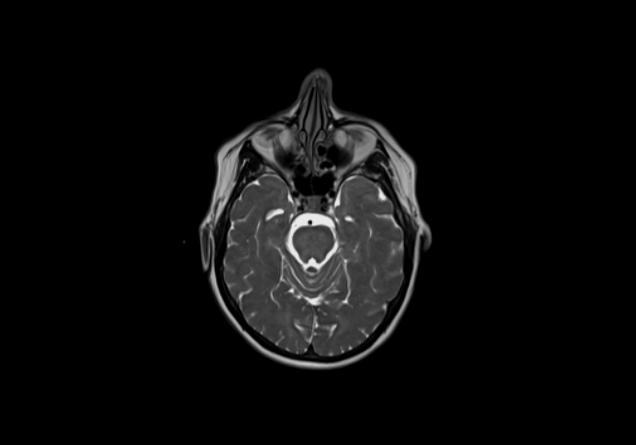 Neck axial  lymph node cross sectional MRI anatomy 3T MRI  image-img-00001-00008.webp